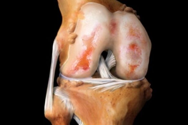 Καταστροφή της άρθρωσης του γόνατος λόγω αρθροπάθειας - μια κοινή παθολογία του μυοσκελετικού συστήματος